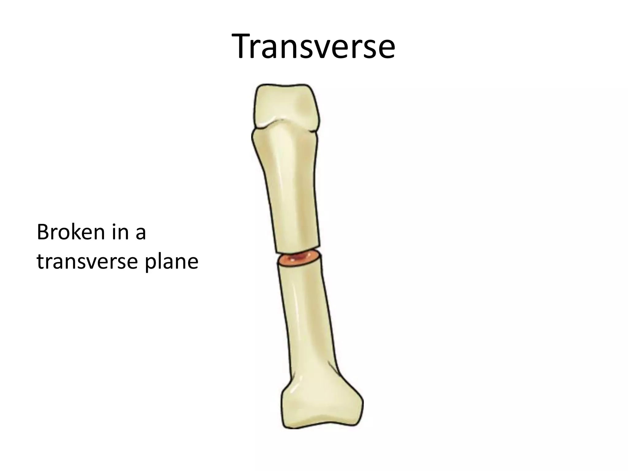 Transverse



Broken in a
transverse plane
 