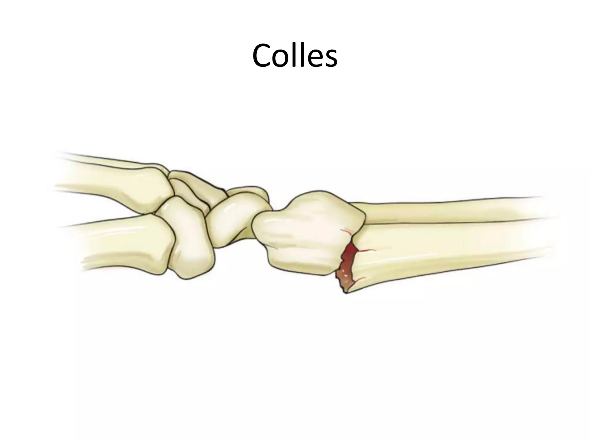 Colles
 
