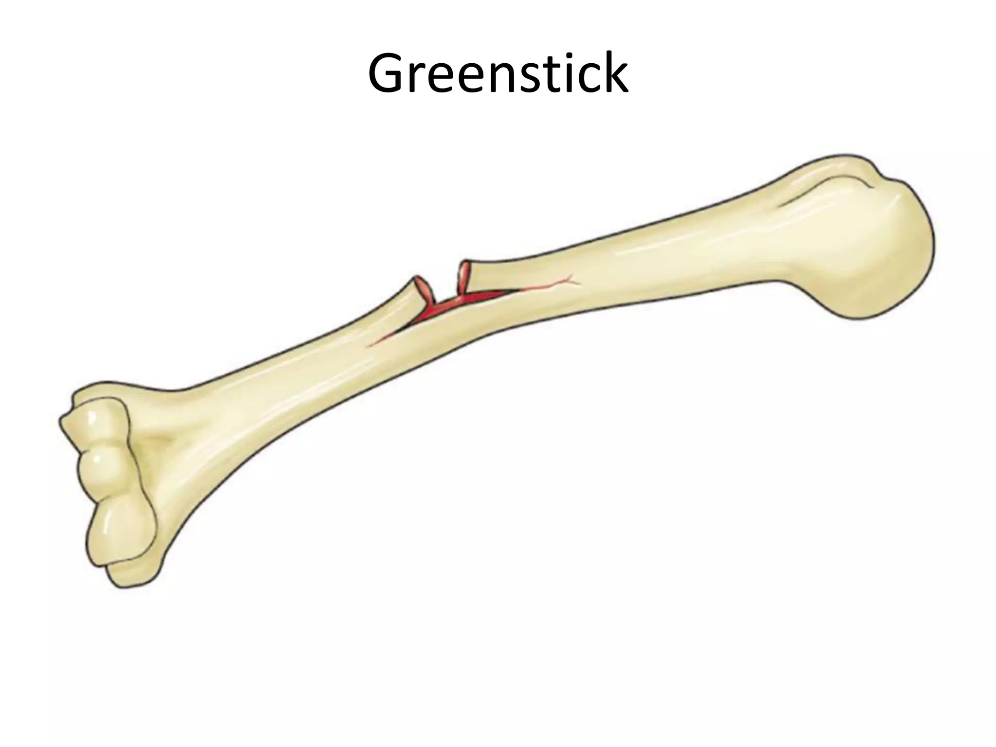Greenstick
 