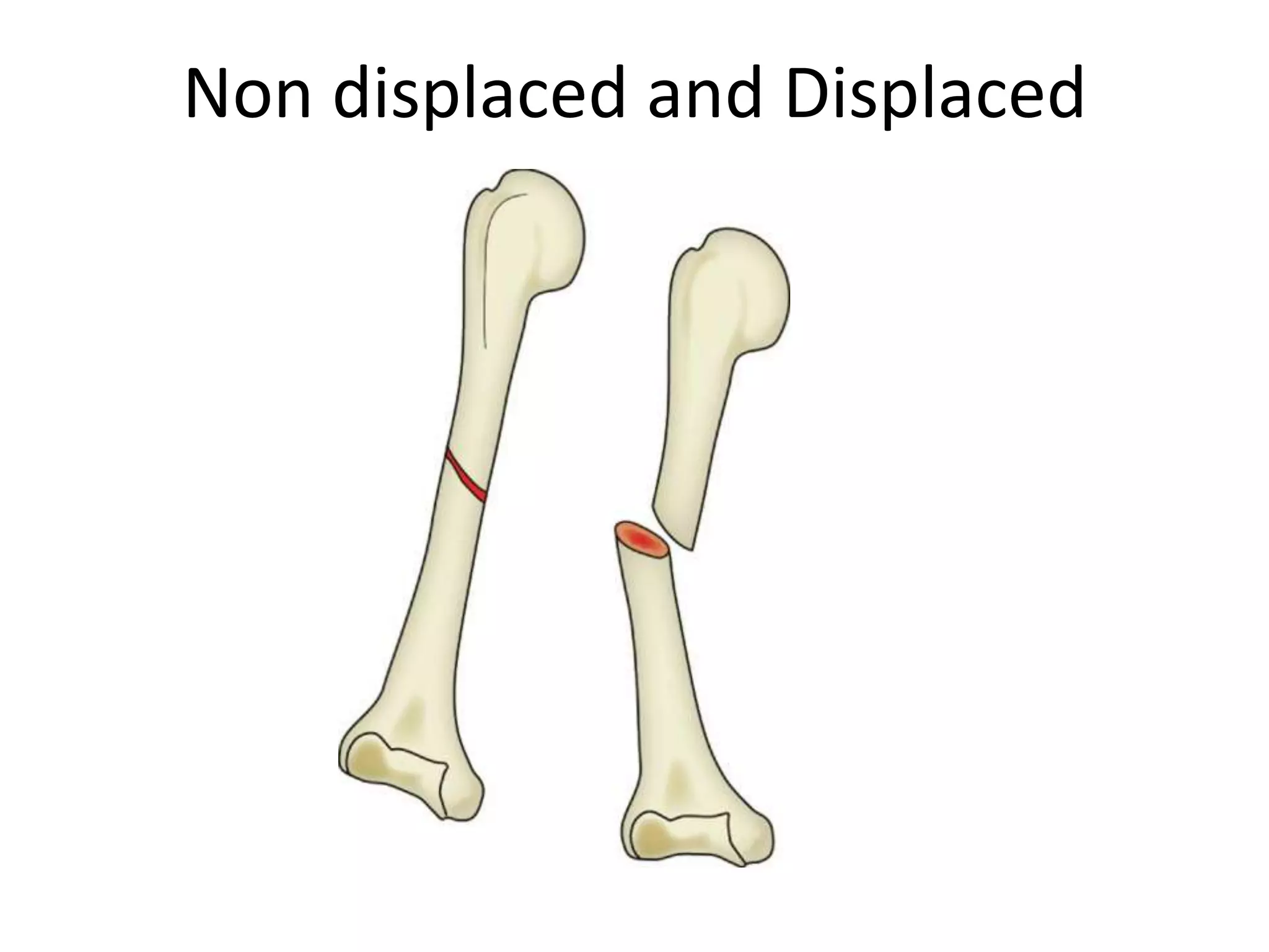 Non displaced and Displaced
 