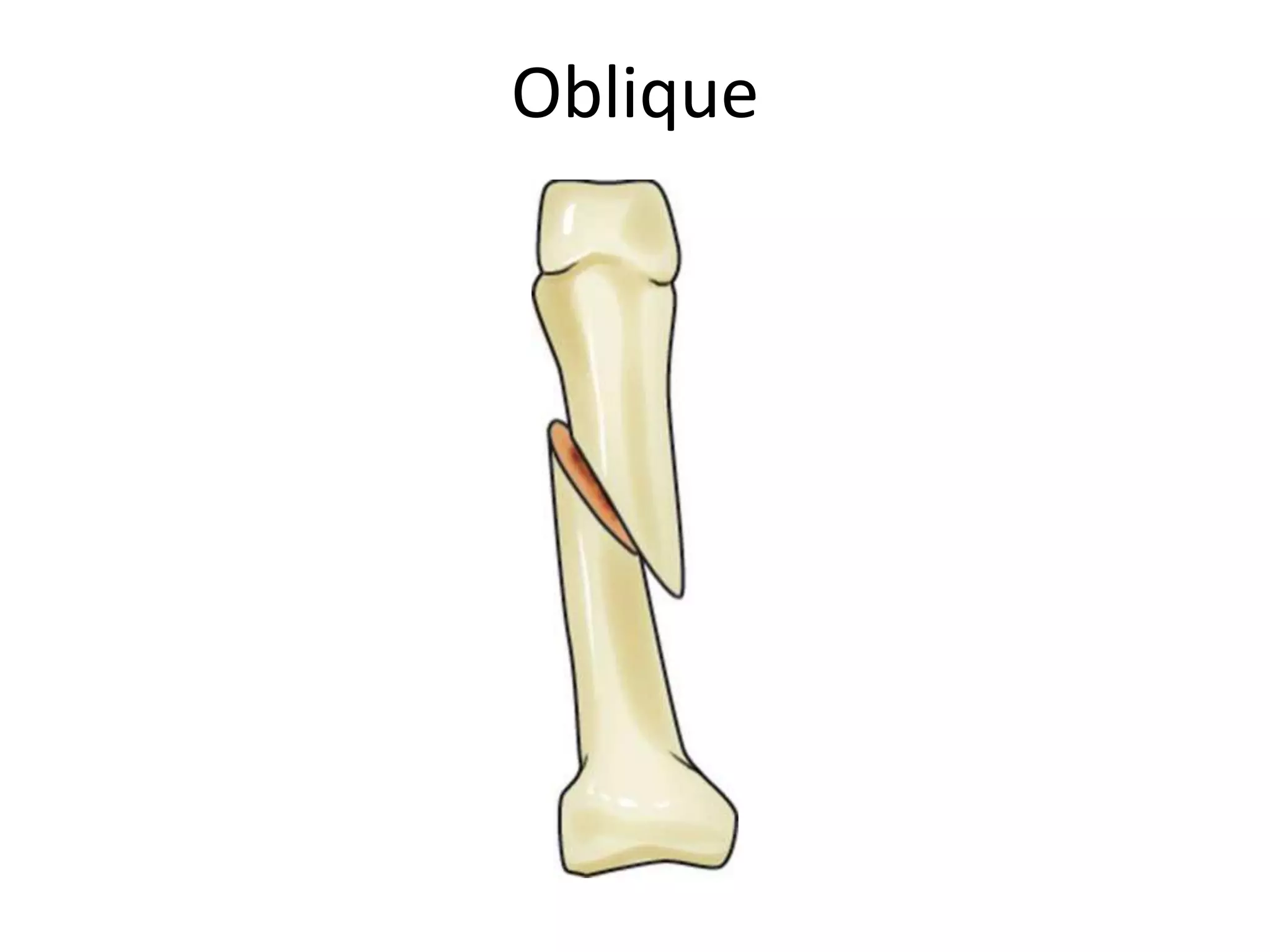 Oblique
 