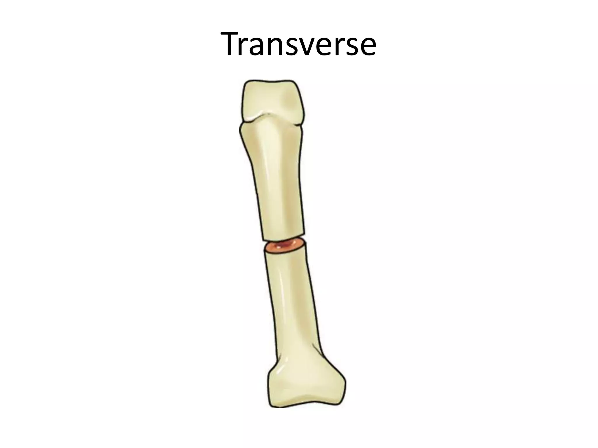 Transverse
 