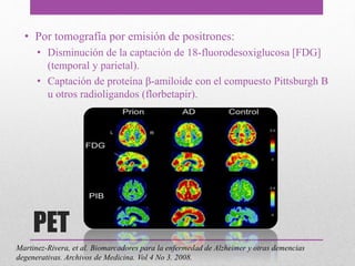 PET
• Por tomografía por emisión de positrones:
• Disminución de la captación de 18-fluorodesoxiglucosa [FDG]
(temporal y parietal).
• Captación de proteína β-amiloide con el compuesto Pittsburgh B
u otros radioligandos (florbetapir).
Martinez-Rivera, et al. Biomarcadores para la enfermedad de Alzheimer y otras demencias
degenerativas. Archivos de Medicina. Vol 4 No 3. 2008.
 