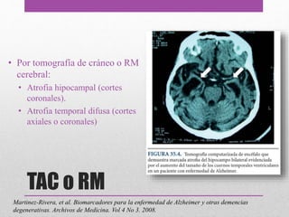 TAC o RM
• Por tomografía de cráneo o RM
cerebral:
• Atrofia hipocampal (cortes
coronales).
• Atrofia temporal difusa (cortes
axiales o coronales)
Martinez-Rivera, et al. Biomarcadores para la enfermedad de Alzheimer y otras demencias
degenerativas. Archivos de Medicina. Vol 4 No 3. 2008.
 