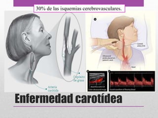 Enfermedad carotídea
30% de las isquemias cerebrovasculares.
 