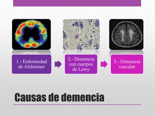 Causas de demencia
1.- Enfermedad
de Alzheimer
2.- Demencia
con cuerpos
de Lewy
3.- Demencia
vascular
 