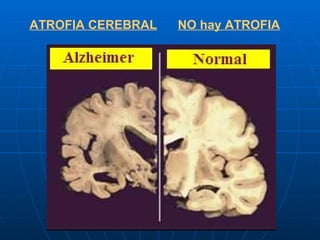 ATROFIA CEREBRAL   NO hay ATROFIA 