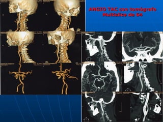 ANGIO TAC con tomógrafo Multislice de 64 
