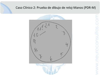 Antiarritmicos: Amiodarona