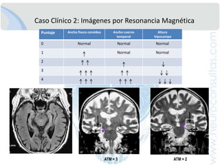 DeterioroCognitivoLeve: Sub-tiposDeterioro Cognitivo LeveSiNoMemoria Comprometida?DCL AmnésicoDCL No AmnésicoSólo compromiso dominio cognitivo No-MemoriaNoSiSólo compromiso MemoriaNoSiDCL Amnésico dominio únicoDCL Amnésico dominio múltipleDCL No-Amnésico dominio únicoDCL No-Amnésico dominio múltiplePetersen RC. J InternMed 2004;256:183-194