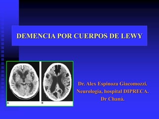 DEMENCIA POR CUERPOS DE LEWY 
Dr. Alex Espinoza Giacomozzi. 
Neurología, hospital DIPRECA. 
Dr Chaná. 
 