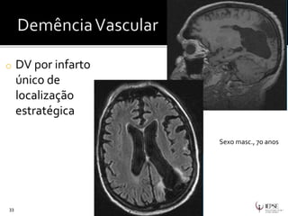 o DV por infarto
único de
localização
estratégica
33
Sexo masc., 70 anos
 