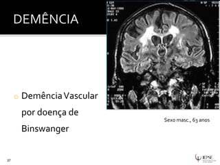 o DemênciaVascular
por doença de
Binswanger
37
Sexo masc., 63 anos
 