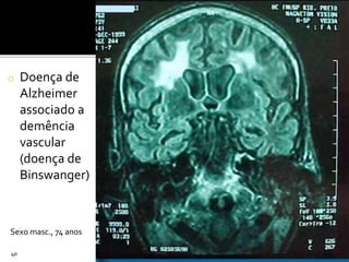 o Doença de
Alzheimer
associado a
demência
vascular
(doença de
Binswanger)
40
Sexo masc., 74 anos
 