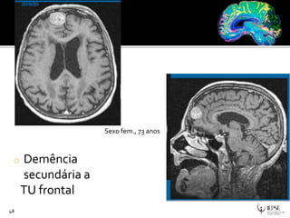 o Demência
secundária a
TU frontal
48
Sexo fem., 73 anos
 