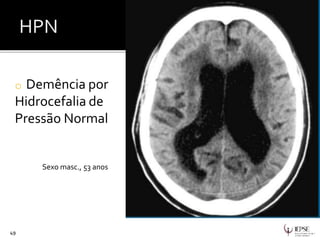 o Demência por
Hidrocefalia de
Pressão Normal
49
Sexo masc., 53 anos
 