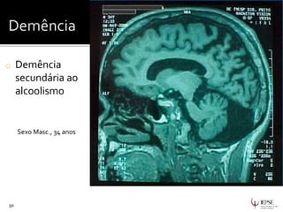 o Demência
secundária ao
alcoolismo
50
Sexo Masc., 34 anos
 