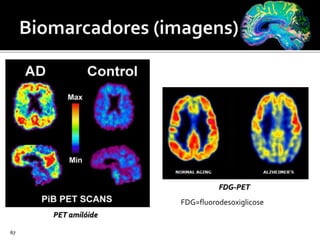 67
PET amilóide
FDG-PET
FDG=fluorodesoxiglicose
 