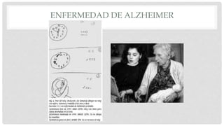 ENFERMEDAD DE ALZHEIMER 
 
