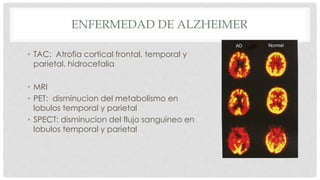 ENFERMEDAD DE ALZHEIMER 
• TAC: Atrofia cortical frontal, temporal y 
parietal. hidrocefalia 
• MRI 
• PET: disminucion del metabolismo en 
lobulos temporal y parietal 
• SPECT: disminucion del flujo sanguineo en 
lobulos temporal y parietal 
 