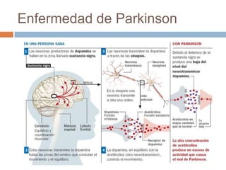 Enfermedad de Parkinson
 