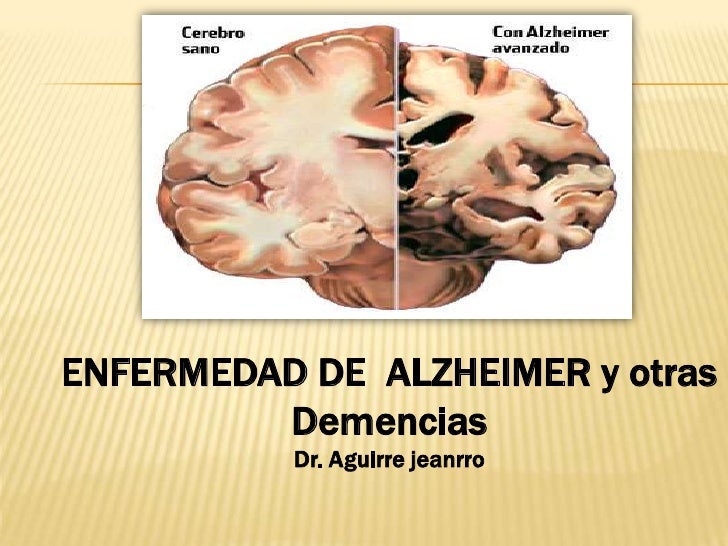 Resultado de imagen para alzheimer