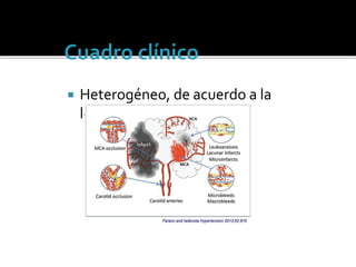  Heterogéneo, de acuerdo a la
lesión vascular
 