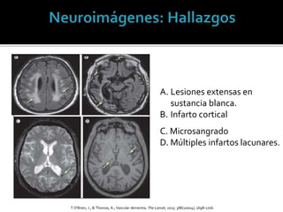 A. Lesiones extensas en
sustancia blanca.
B. Infarto cortical
C. Microsangrado
D. Múltiples infartos lacunares.
T O'Brien, J., & Thomas, A.; Vascular dementia. The Lancet, 2015: 386(10004), 1698-1706.
 