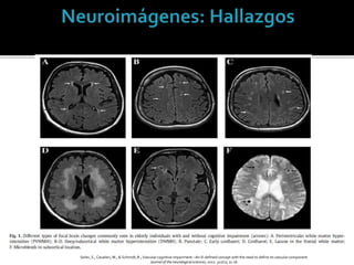 Seiler, S., Cavalieri, M., & Schmidt, R.; Vascular cognitive impairment—An ill-defined concept with the need to define its vascular component.
Journal of the neurologicalsciences, 2012: 322(1), 11-16.
 