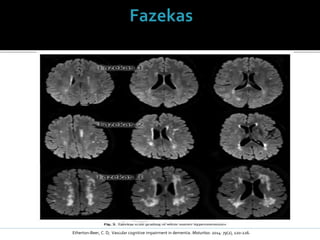 Etherton-Beer, C. D; Vascular cognitive impairment in dementia. Maturitas: 2014: 79(2), 220-226.
 