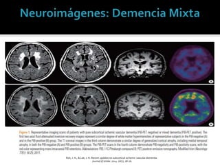 Roh, J. H., & Lee, J. H. Recent updates on subcortical ischemic vascular dementia.
Journal of stroke: 2014. 16(1), 18-26.
 
