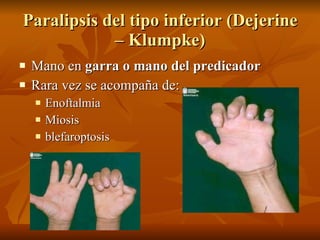 Paralipsis del tipo inferior (Dejerine – Klumpke) <ul><li>Mano en  garra   o mano del predicador </li></ul><ul><li>Rara ve...