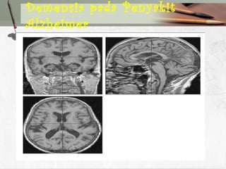 Demensia pada Penyakit
Alzheimer
 