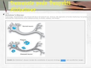 Demensia pada Penyakit
Alzheimer
 