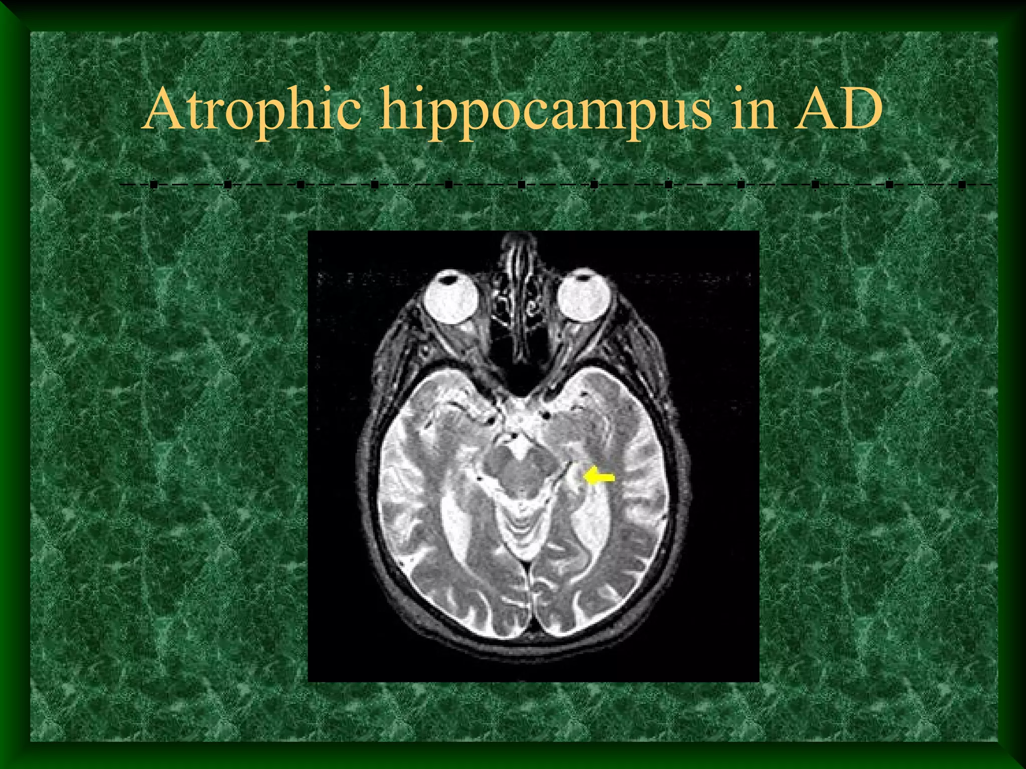 Atrophic hippocampus in AD
 