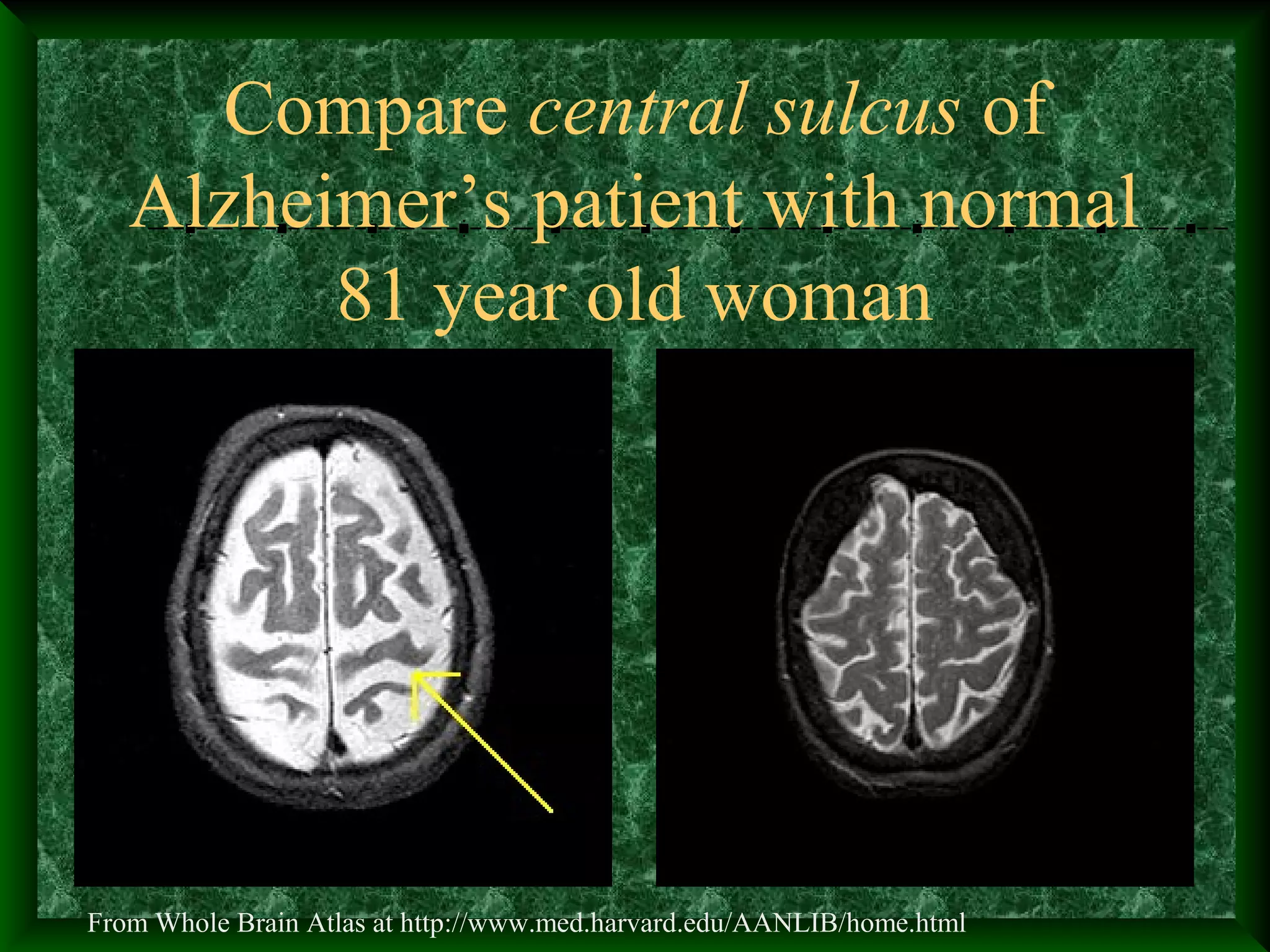 Compare central sulcus of
Alzheimer’s patient with normal
81 year old woman
From Whole Brain Atlas at http://www.med.harvard.edu/AANLIB/home.html
 