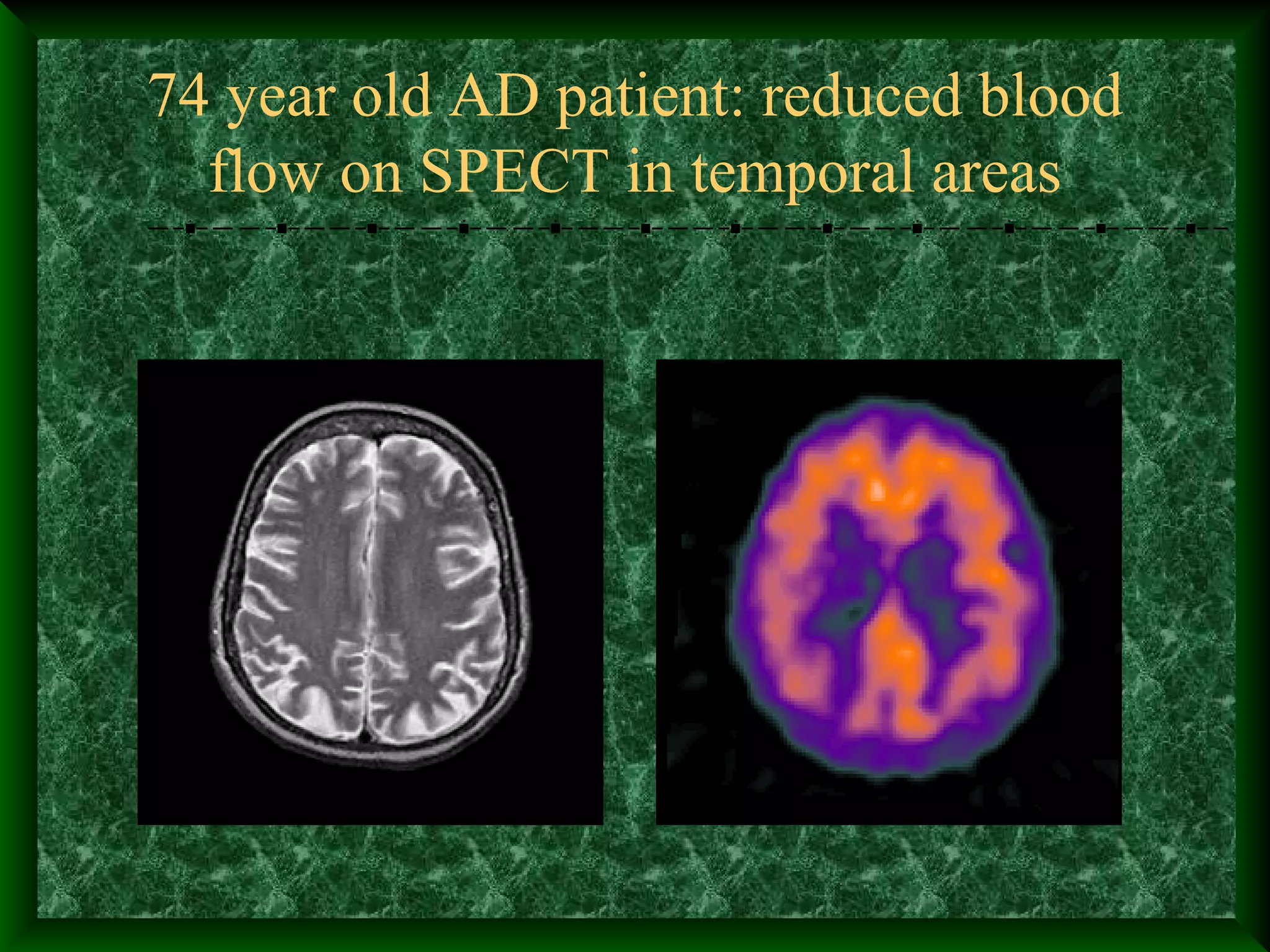 74 year old AD patient: reduced blood
flow on SPECT in temporal areas
 