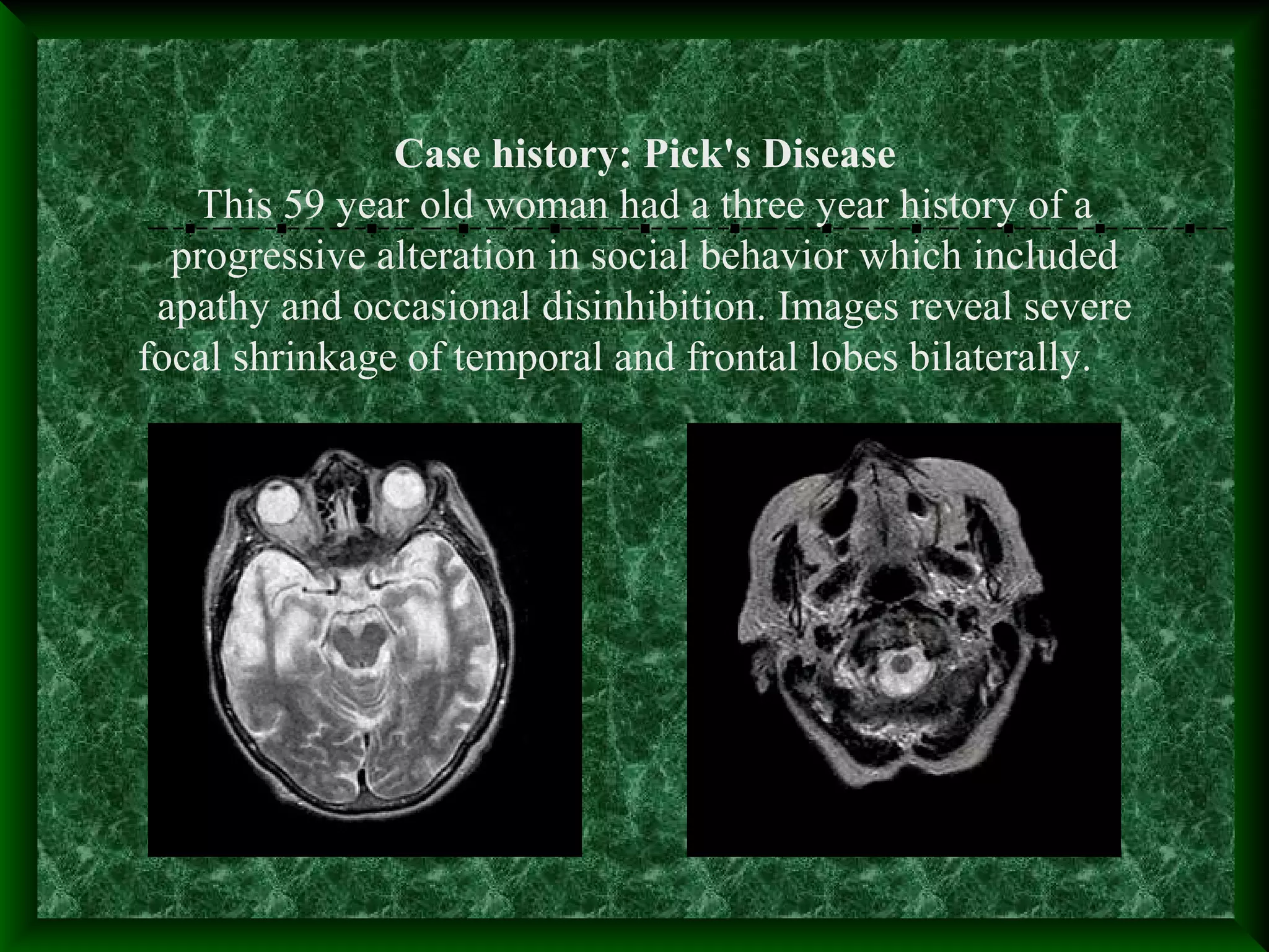 Case history: Pick's Disease
This 59 year old woman had a three year history of a
progressive alteration in social behavior which included
apathy and occasional disinhibition. Images reveal severe
focal shrinkage of temporal and frontal lobes bilaterally.
 