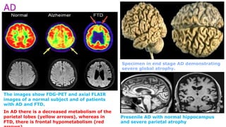Specimen in end stage AD demonstrating
severe global atrophy.
The images show FDG-PET and axial FLAIR
images of a normal subject and of patients
with AD and FTD.
In AD there is a decreased metabolism of the
parietal lobes (yellow arrows), whereas in
FTD, there is frontal hypometabolism (red
Presenile AD with normal hippocampus
and severe parietal atrophy
AD
 