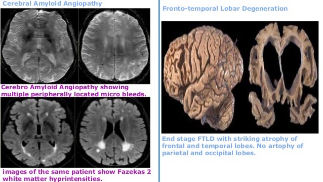 Frontal lobe dementia sex