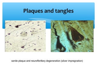 Plaques and tangles
senile plaque and neurofibrillary degeneration (silver impregnation)
 