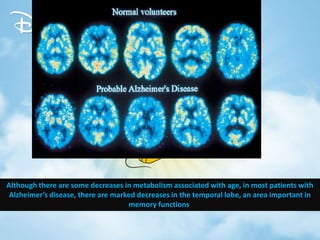 Although there are some decreases in metabolism associated with age, in most patients with
Alzheimer’s disease, there are marked decreases in the temporal lobe, an area important in
memory functions.
 