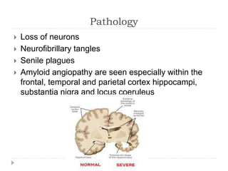 Pathology
 Loss of neurons
 Neurofibrillary tangles
 Senile plagues
 Amyloid angiopathy are seen especially within the
frontal, temporal and parietal cortex hippocampi,
substantia nigra and locus coeruleus
 