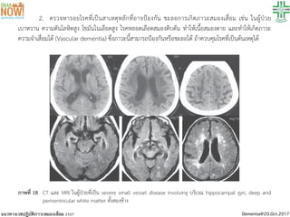 Dementia@20.Oct.2017แนวทางเวชปฏิบัตินี้ เปนเครื่องมือสงเสริมคุณภาพในการบริการดานสุขภาพที่เหมาะสมกับทรัพยากรและเงื่อนไขในสังคมไทย โดยหวังผลในการสรางเสริมและแกไขปญหา
2. ตรวจหารอยโรคที่เปนสาเหตุหลักที่อาจปองกัน ชะลอการเกิดภาวะสมองเสื่อม เชน ในผูปวย
เบาหวาน ความดันโลหิตสูง ไขมันในเลือดสูง โรคหลอดเลือดสมองตีบตัน ทำใหเนื้อสมองตาย และทำใหเกิดภาวะ
ความจำเสื่อมได (Vascular dementia) ซึ่งภาวะนี้สามารถปองกันหรือชะลอได ถาควบคุมโรคที่เปนตนเหตุได
ภาพที่ 18 CT และ MRI ในผูปวยที่เปน severe small vessel disease involving บริเวณ hippocampal gyri, deep and
periventricular white matter ทั้งสองขาง
แนวทางเวชปฏิบัติภาวะสมองเสื่อม 2557
 