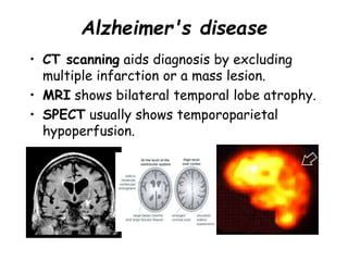 Alzheimer's disease
• CT scanning aids diagnosis by excluding
multiple infarction or a mass lesion.
• MRI shows bilateral temporal lobe atrophy.
• SPECT usually shows temporoparietal
hypoperfusion.
 