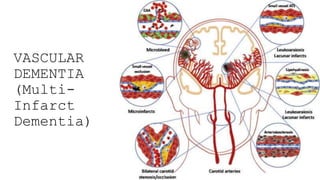 VASCULAR
DEMENTIA
(Multi-
Infarct
Dementia)
 