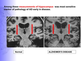 Among these measurements of hippocampus was most sensitive
marker of pathology of AD early in disease.
Normal ALZHEIMER’S DISEASE
 