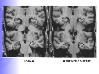 ALZHEIMER’S DISEASENORMAL
 