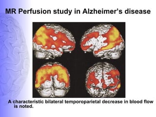 MR Perfusion study in Alzheimer’s disease
A characteristic bilateral temporoparietal decrease in blood flow
is noted.
 