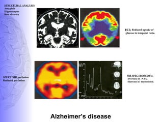 STRUCTURAL ANALYSIS
Amygdala
Hippocampus
Rest of cortex
PET: Reduced uptake of
glucose in temporal lobe.
SPECT/MR perfusion
Reduced perfusion
MR SPECTROSCOPY:
-Decrease in NAA.
-Increase in myoinositol.
Alzheimer’s disease
 